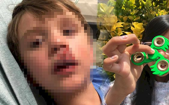 UWAGA! Fidget Spinner EKSPLODOWAŁ w twarz dziecka! (ZDJĘCIA)