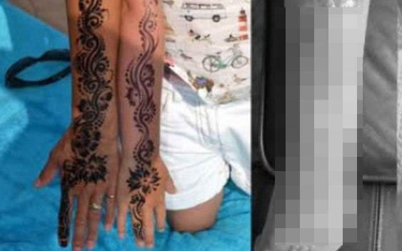 7-latka wykonała na wakacjach tatuaż z henny. Zrobił z jej skórą COŚ STRASZNEGO