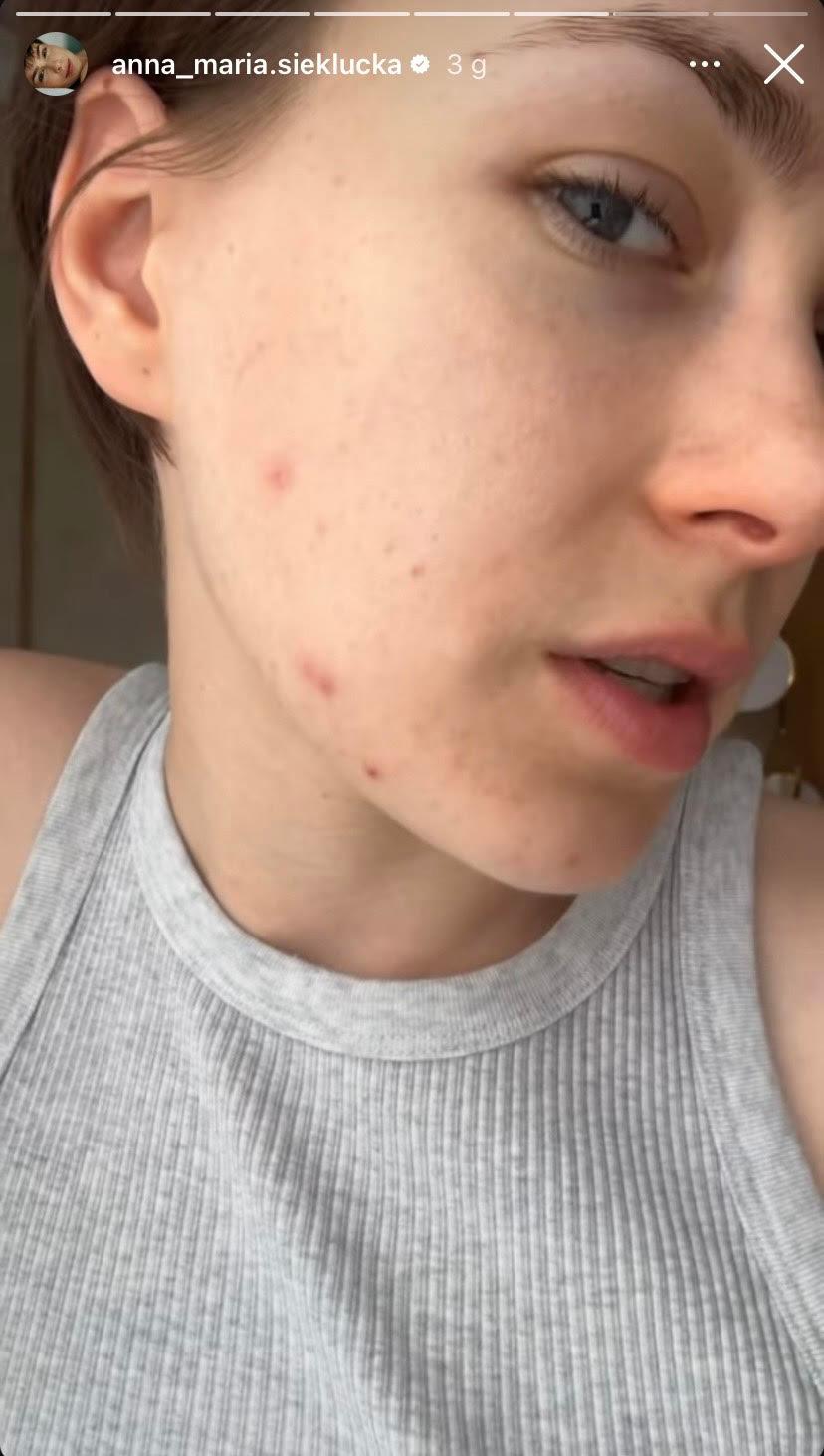 Anna-Maria Sieklucka o swojej cerze