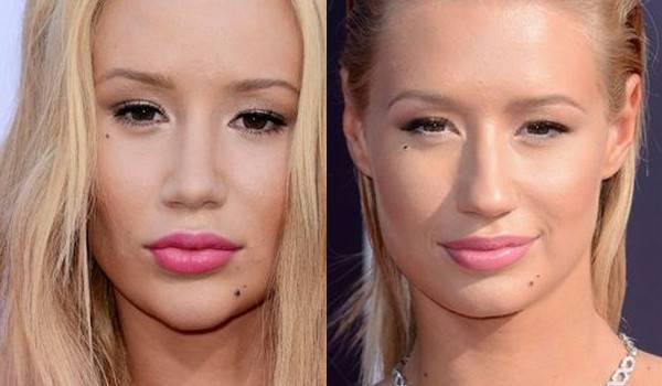 Jak operacja nosa zmieniała twarze gwiazd