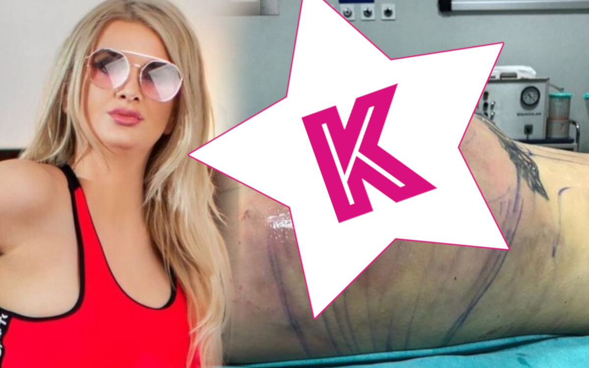 Uczestniczka Projekt Lady pokazała SZOKUJĄCE zdjęcia po operacji powiększenia pupy: “Miałam drgawki 3 godziny”