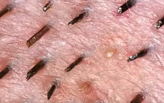 Oglądanie wyciskania pryszczy pod zoomem jest absolutnie straszne i fascynujące