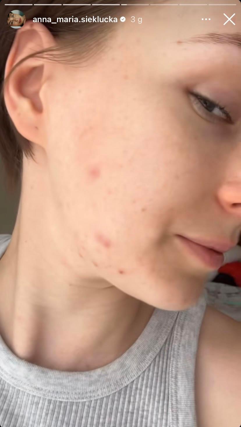 Anna-Maria Sieklucka o swojej cerze