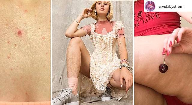 Szwedzka modelka pokazuje krosty, cellulit i włosy na nogach (ZDJĘCIA)