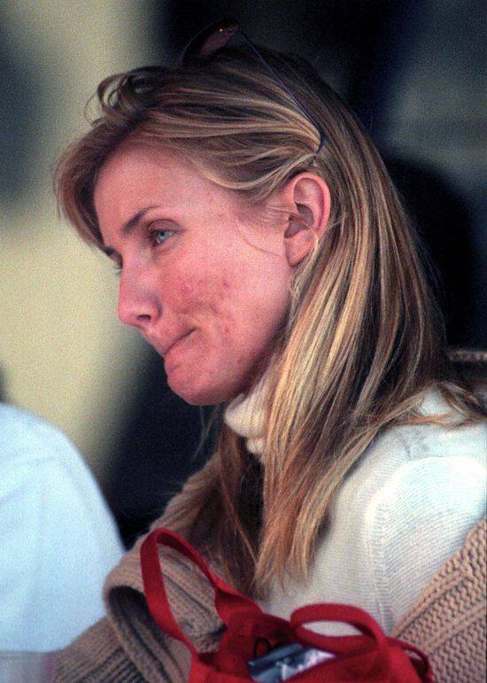 Gwiazdy z trądzikiem