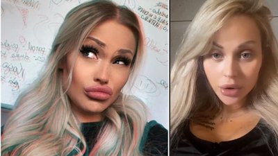 EwelOna cierpi po operacji powiększenia biustu: Mam wrażenie, że ROZPRUWAJĄ mi się SUTKI