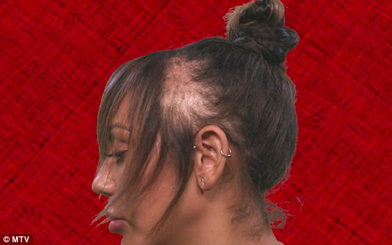 Ta gwiazdka przez lata nosiła doczepy, teraz płacze i pokazuje jak łysieje