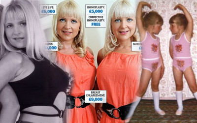 Oto Jo i Kerry Burton – bliźniaczki uzależnione od operacji