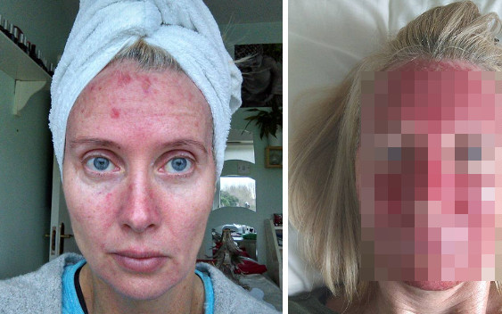 Ta kobieta spaliła sobie twarz! A wszystko przez… UWAŻAJCIE!