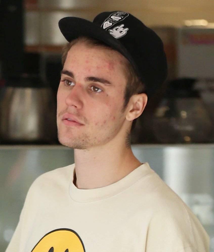 Justin ma poważne problemy z cerą – nie wygląda dobrze