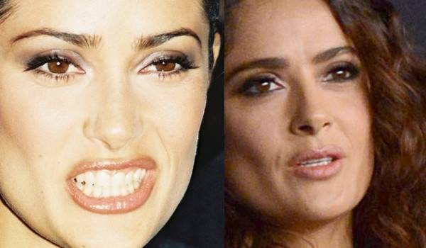 Jak operacja nosa zmieniała twarze gwiazd