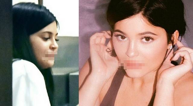 Co się dzieje z ustami Kylie?! Na temat jej wielkich warg wypowiedział się EKSPERT