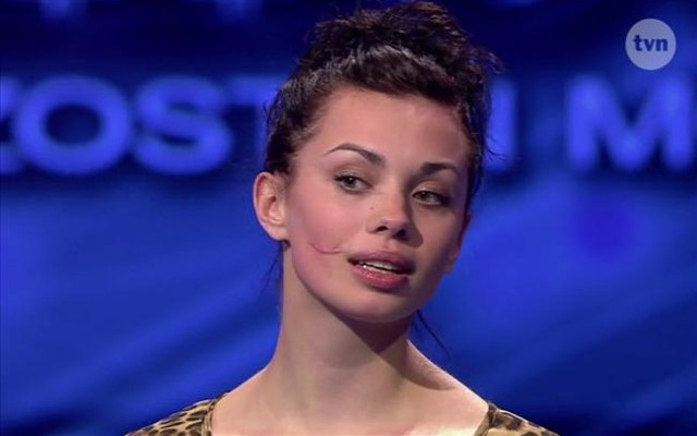 Anna Koryto – dziewczyna z blizną na twarzy w Top Model