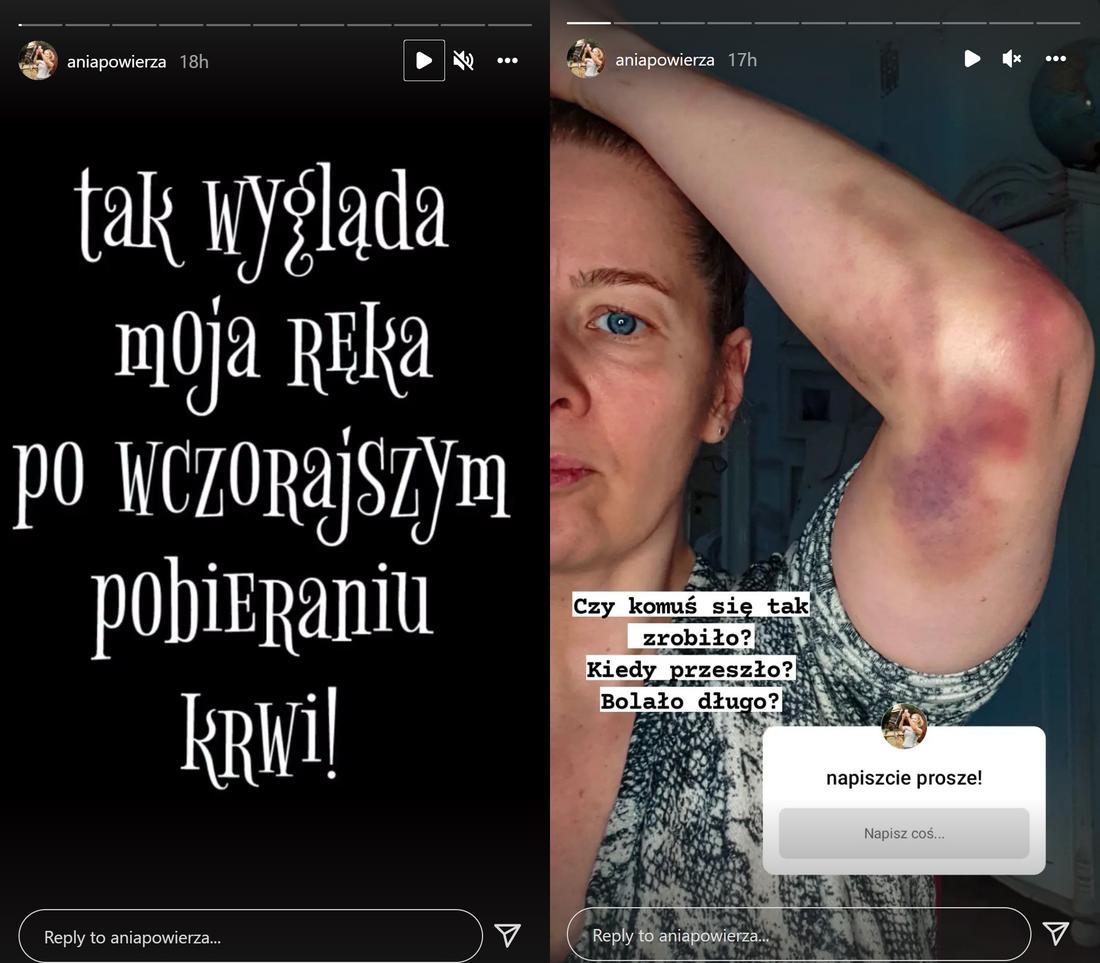 Anna Powierza pokazała rękę całą w SINIAKACH! Co się stało?