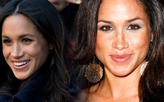 Chirurg plastyczny o operacjach, jakie zrobiła Meghan Markle