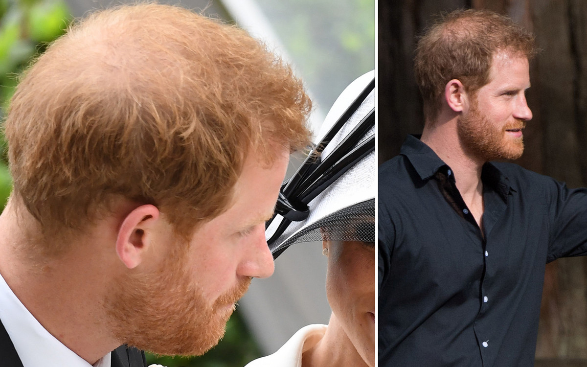 Książę Harry gwałtownie ŁYSIEJE – zobaczcie, jak będzie wyglądał za 2 lata