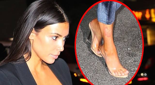 Łuszczyca znów dokucza Kim Kardashian