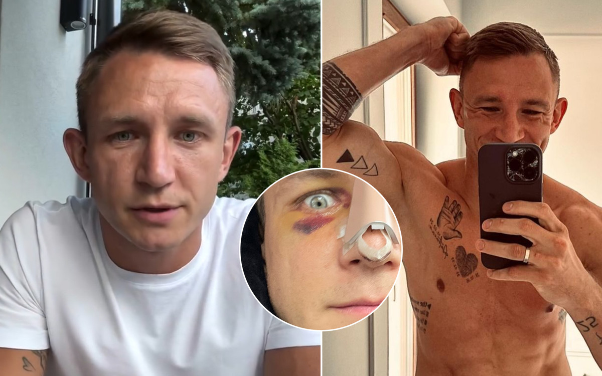 Jakub Rzeźniczak ujawnił, że ma na koncie… DWIE operacje nosa! Pokazał zdjęcie przed i po (FOTO)