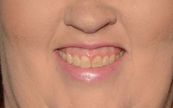 Mama June wydała 10 tysięcy dolarów na nowe zęby