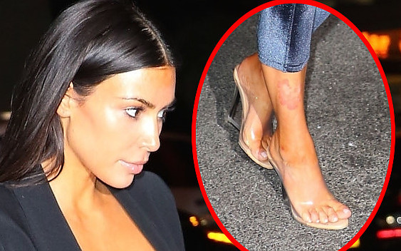 Łuszczyca znów dokucza Kim Kardashian