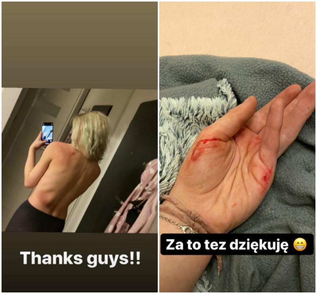 Julia Wróblewska pokazała, co jej się stało podczas strajku kobiet. 