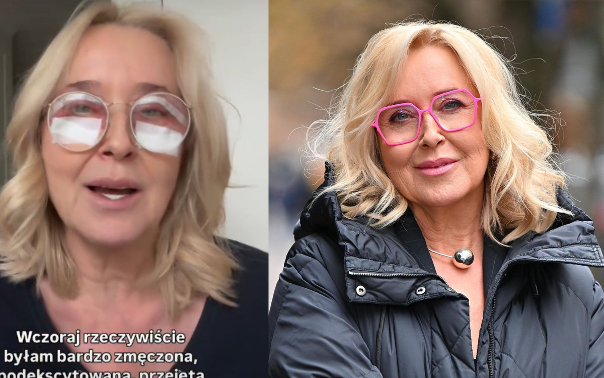 Agata Młynarska przeszła blefaroplastykę. “Nie ma na co czekać”
