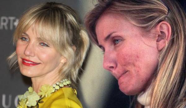 Te gwiazdy borykają się z trądzikiem