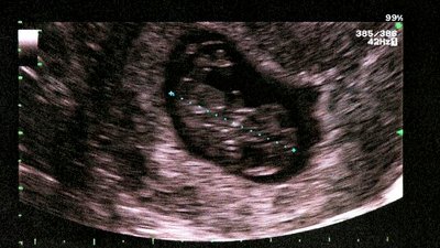 Niemiecka fotografka usunęła ciążę w domu – zdjęcia pokazała na Instagramie