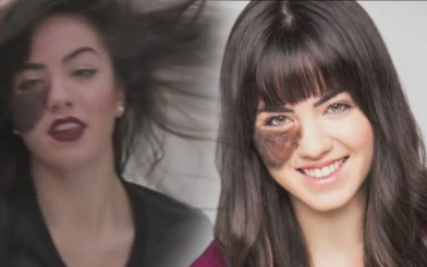 Tancerka ze znamieniem na twarzy nie podda się operacji