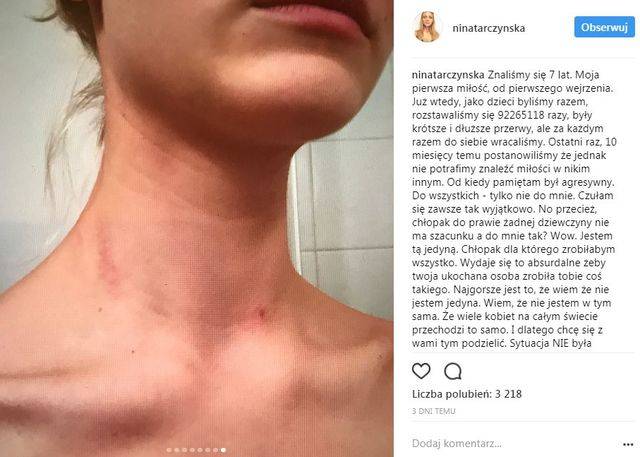 KOSZMAR! Polska modelka POBITA przez chłopaka (Instagram)