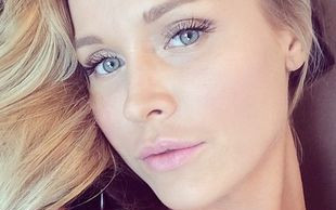 Twarz Joanny Krupy cała w śladach po igle (FOTO)