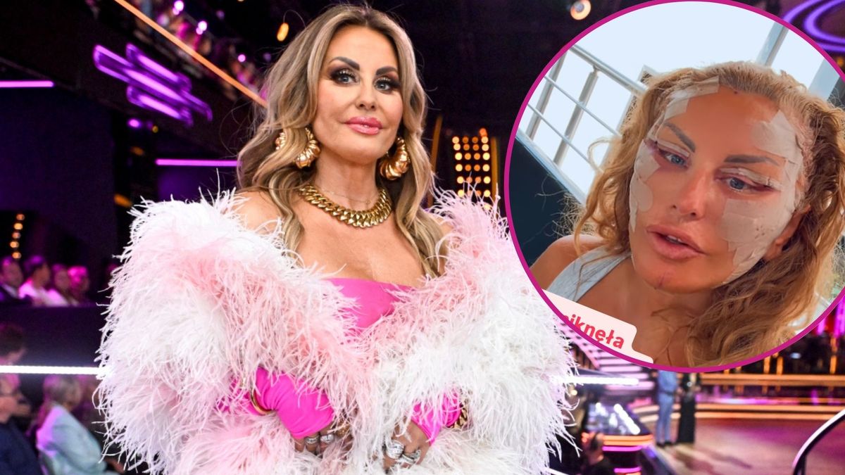 Dagmara Kaźmierska pokazała twarz po operacji. Tak wygląda dzień po zabiegu!