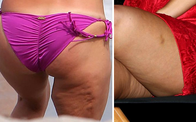 Gwiazdy, które walczą z cellulitem