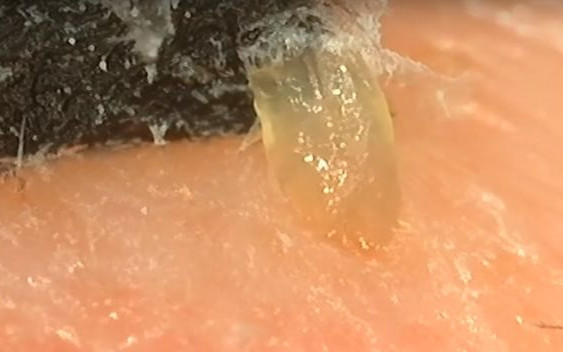 Fascynujące zbliżenie na wągry usuwane za pomocą maseczki