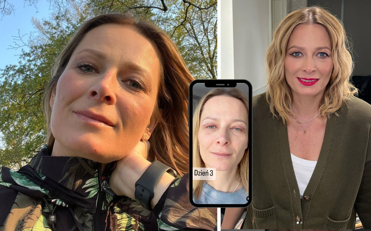 Odeta Moro zdecydowała się na operację plastyczną. Pokazała, jak teraz wygląda jej twarz