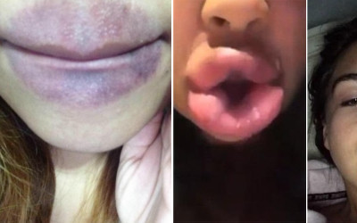 #kyliejennerchallenge, czyli przerażający efekt Kylie Jenner