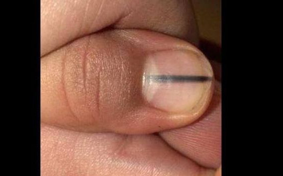 Manikiurzystka uratowała życie klientki! Znalazła TO pod jej paznokciem i…