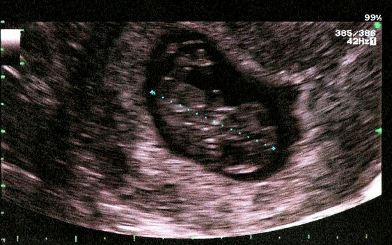 Niemiecka fotografka usunęła ciążę w domu – zdjęcia pokazała na Instagramie