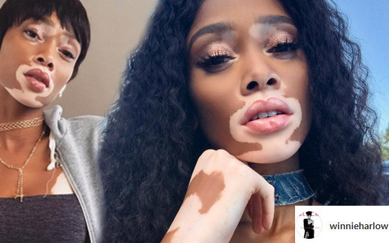 Winnie Harlow, modelka z bielactwem pozuje prawie nago