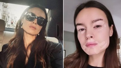 Katarzyna Smutniak pokazała, jak wygląda twarz osoby, która zmaga się z bielactwem