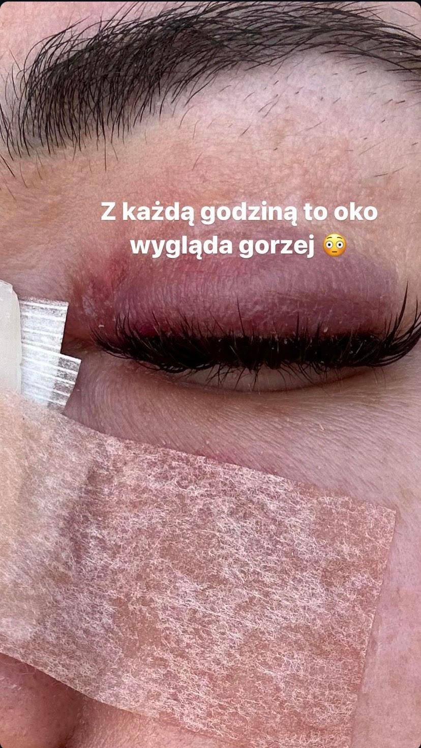 Marianna Schreiber po operacji nosa