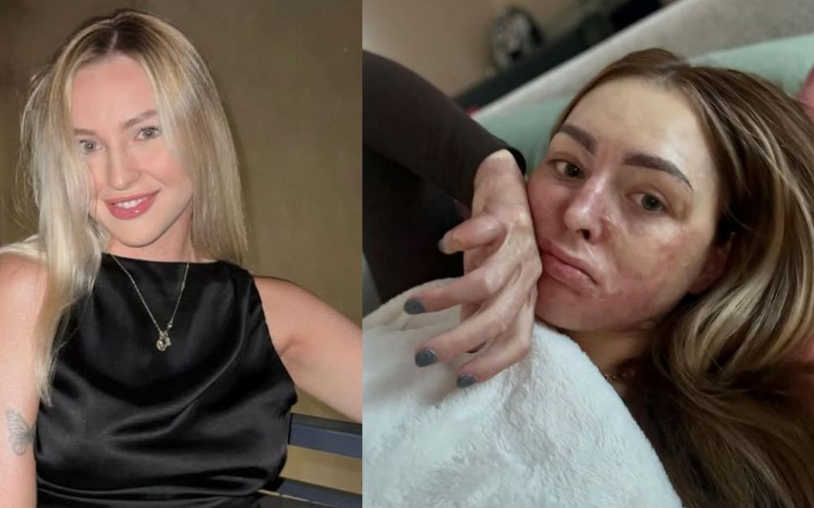 Poparzona Polka wciąż walczy w sądzie. Przykre, co ją spotkało