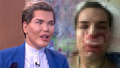 Żywemu Kenowi ODPADA NOS! Rodrigo Alves przesadził z operacjami