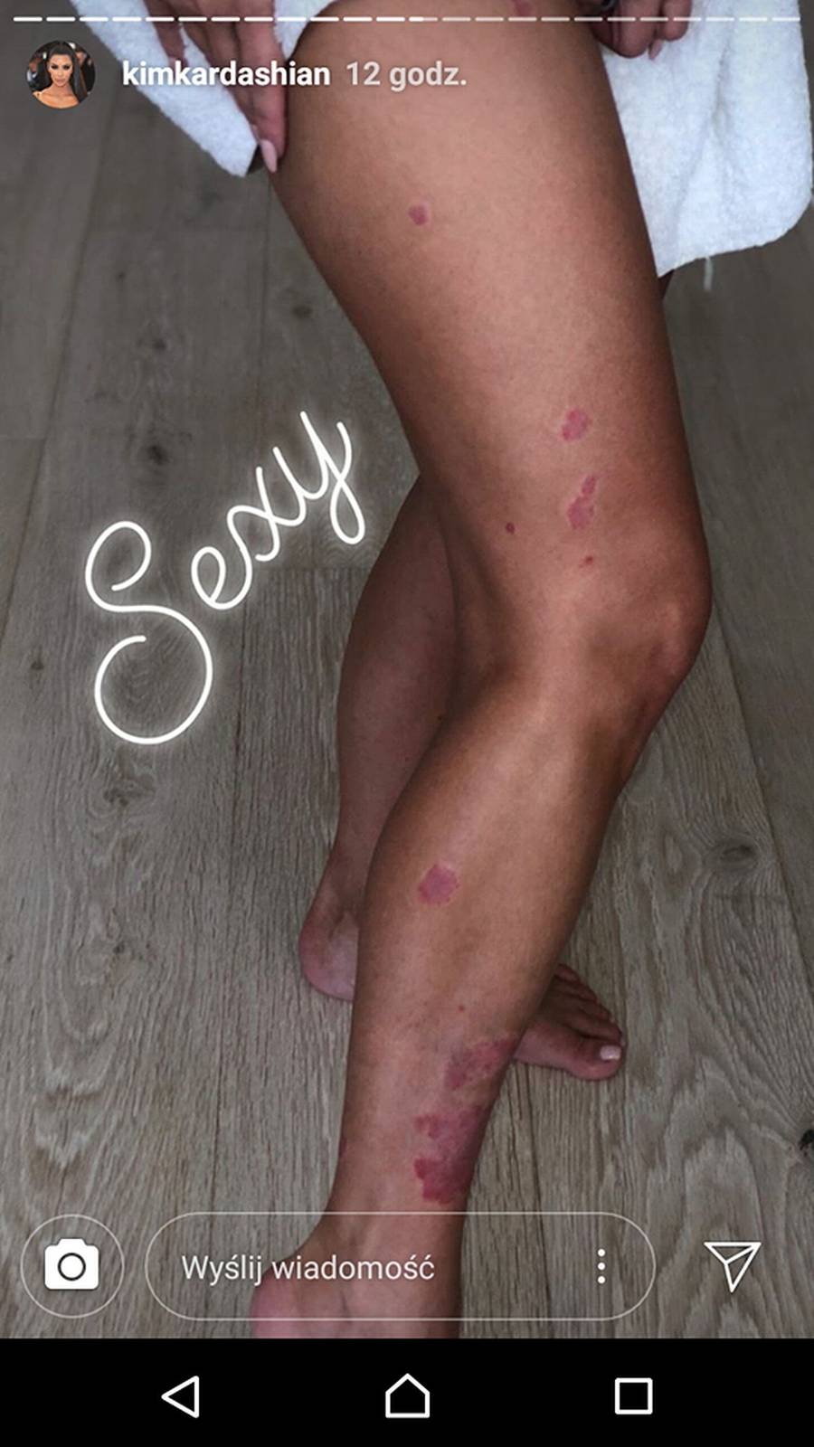 Kim Kardashian pokazała PRZERAŻAJĄCE zdjęcia z łuszczycą