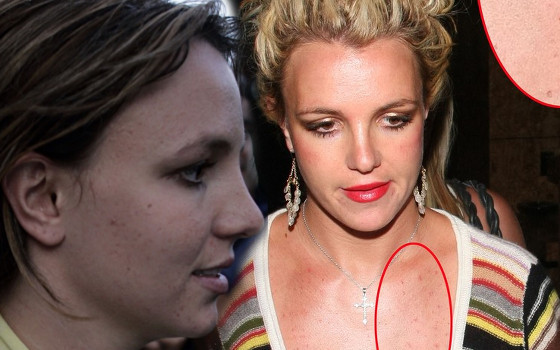 Te gwiazdy borykają się z trądzikiem