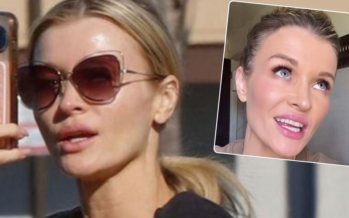 Dramat Joanny Krupy. Lekarze zrujnowali jej twarz