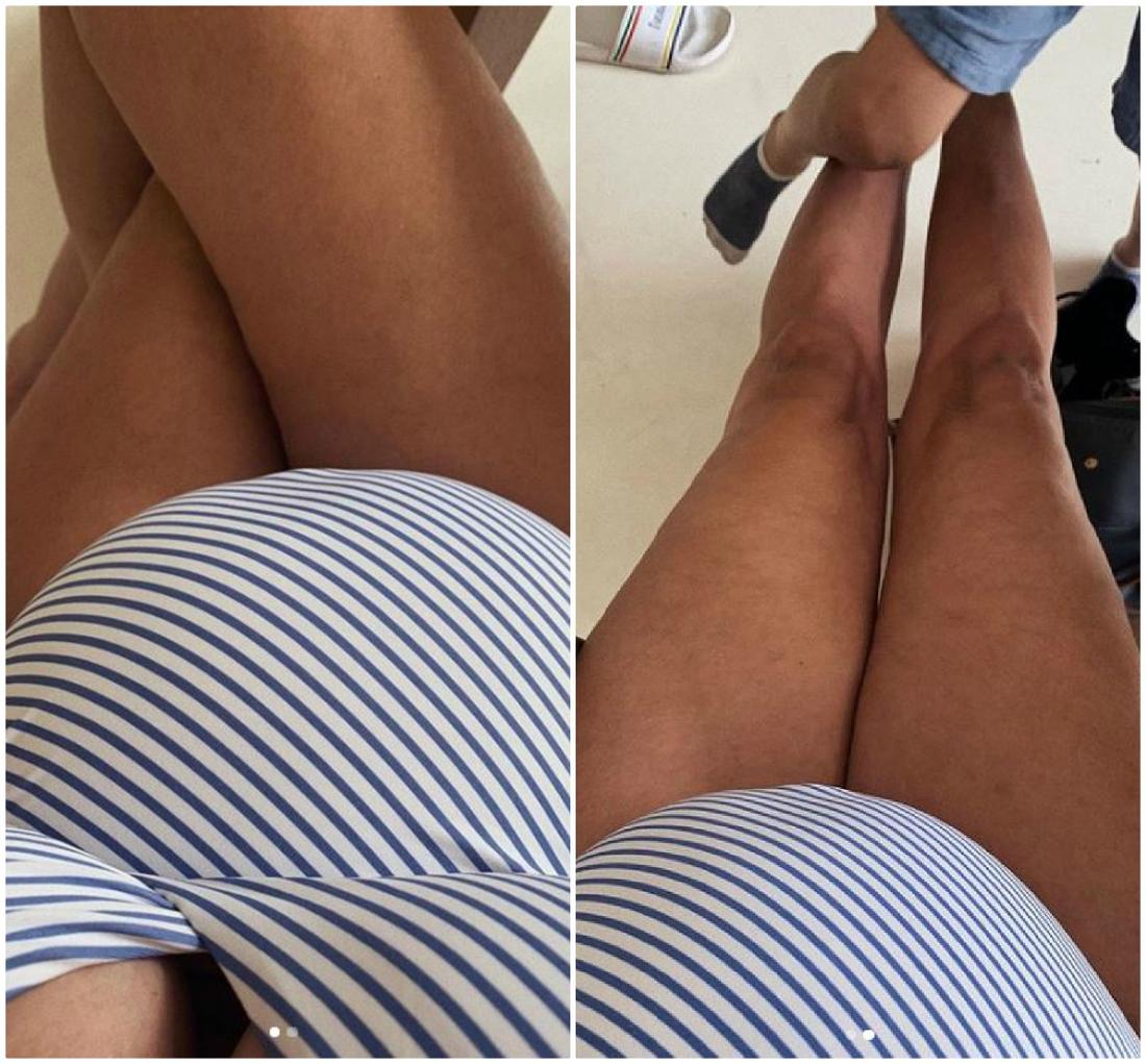 Aleksandra Żebrowska pokazała cellulit na nogach. 