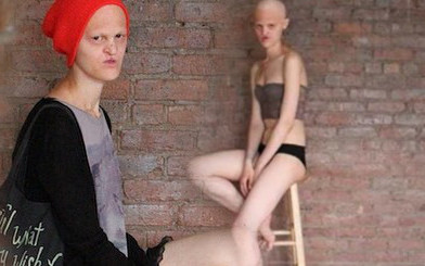 Melanie Gaydos – modelka high fashion z chorobą genetyczną