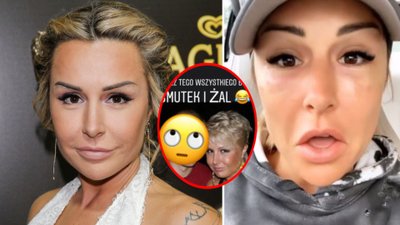 Blanka Lipińska opowiada, co zrobiła z twarzą: wolumetria, zmieniony kształt żuchwy… i pokazuje, jak wyglądała KIEDYŚ