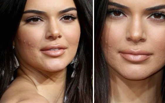 Co się dzieje z twarzą Kendall Jenner? (ZDJĘCIA)
